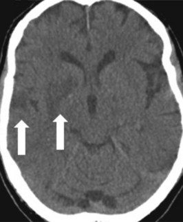A 68-year-old woman with a left hemiplegia following a conscious ...
