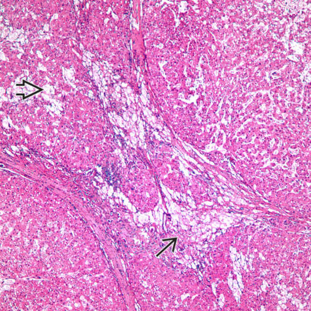 Niemann-Pick Disease  Concise Medical Knowledge