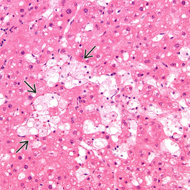 Hepatocellular carcinoma as a complication of Niemann‐Pick disease