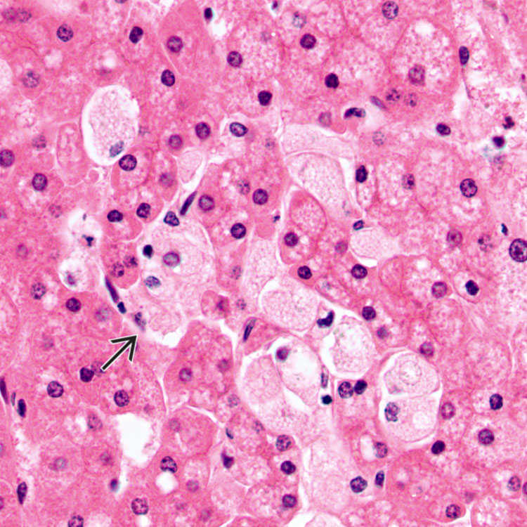 Morphology of Niemann-Pick type C metabolic storage disorder