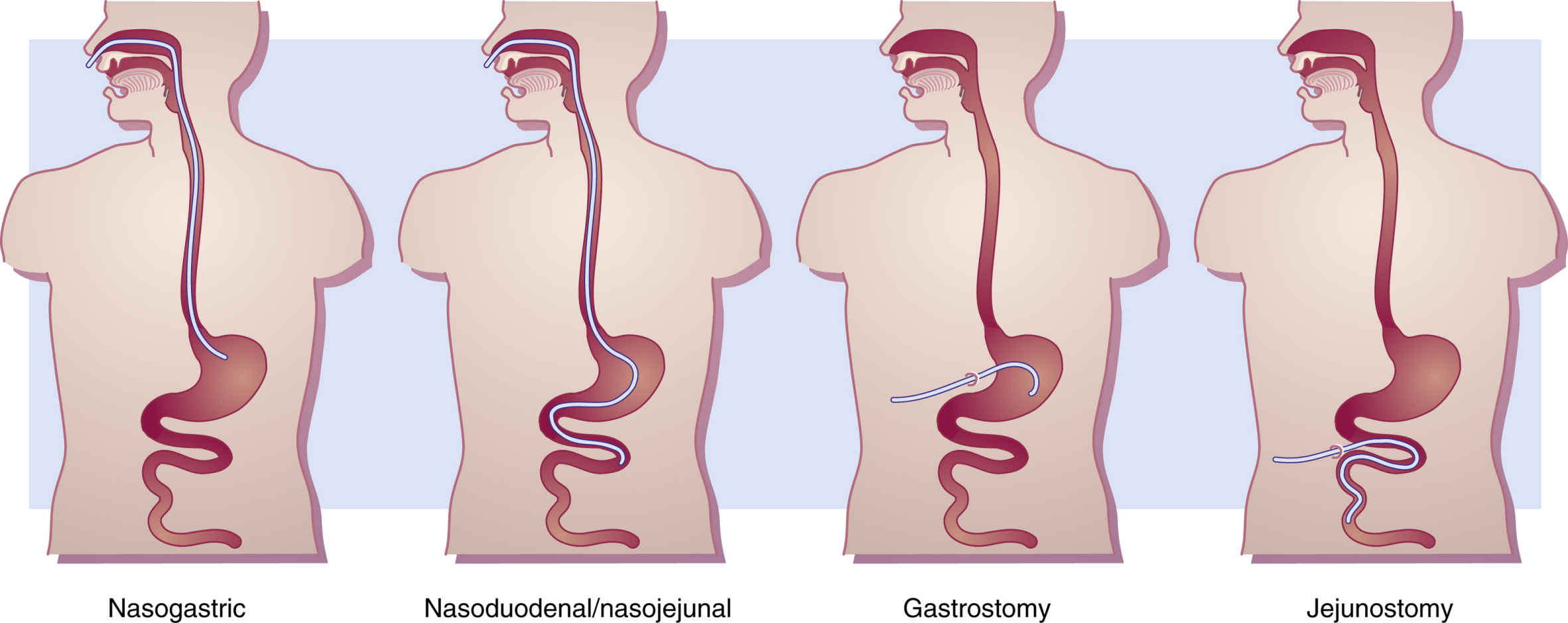 Types Of Tube Feeding Methods