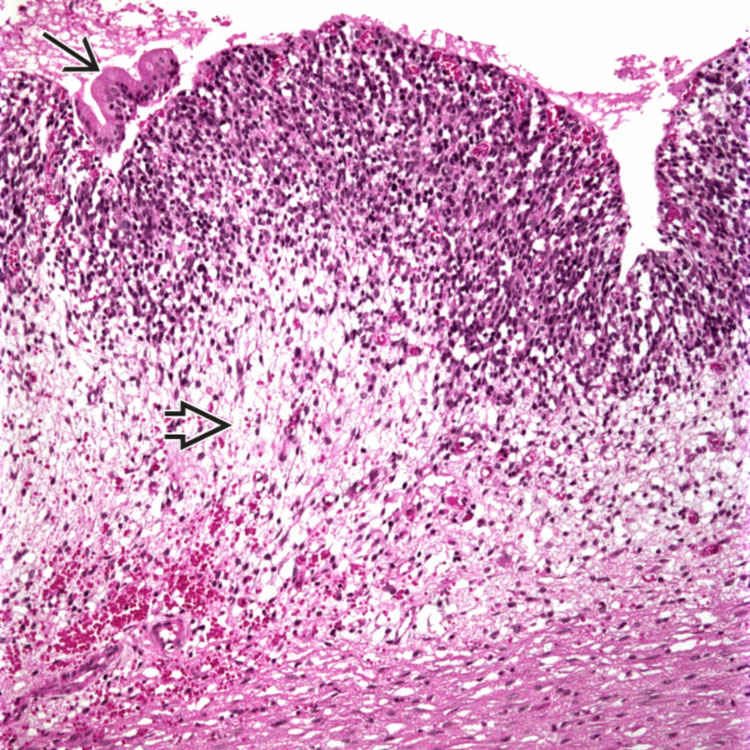 Embryonal Rhabdomyosarcoma | Basicmedical Key