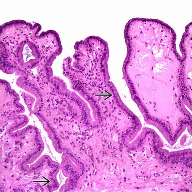 Gallbladder Polyp Histology