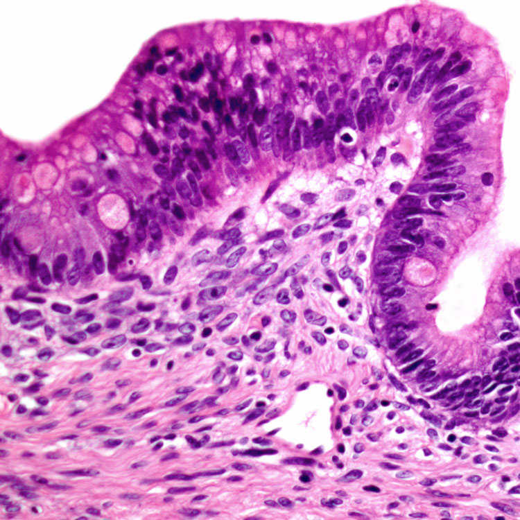 mucinous-cystic-neoplasm-basicmedical-key