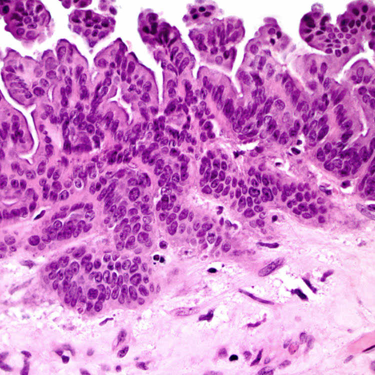 mucinous-cystic-neoplasm-basicmedical-key