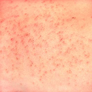 Eruptive vellus hair cysts an original case occurring in twins  Pauline   2015  International Journal of Dermatology  Wiley Online Library