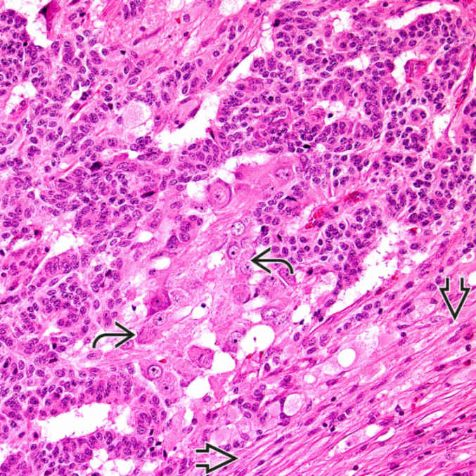 Paraganglioma | Basicmedical Key