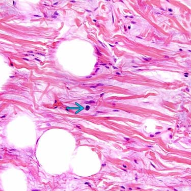 spindle cells and ropey collagen- found in spindle cell lipomas