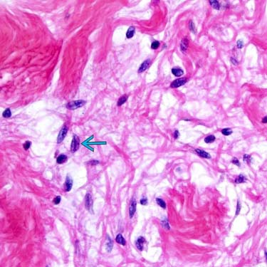 spindle cells and ropey collagen- found in spindle cell lipomas