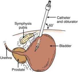 Suprapubic Catheter Insertion And/or Change | Basicmedical Key