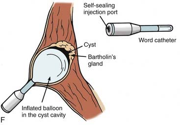 Bartholin’s Cyst And Abscess: Word Catheter Insertion, Marsupialization ...