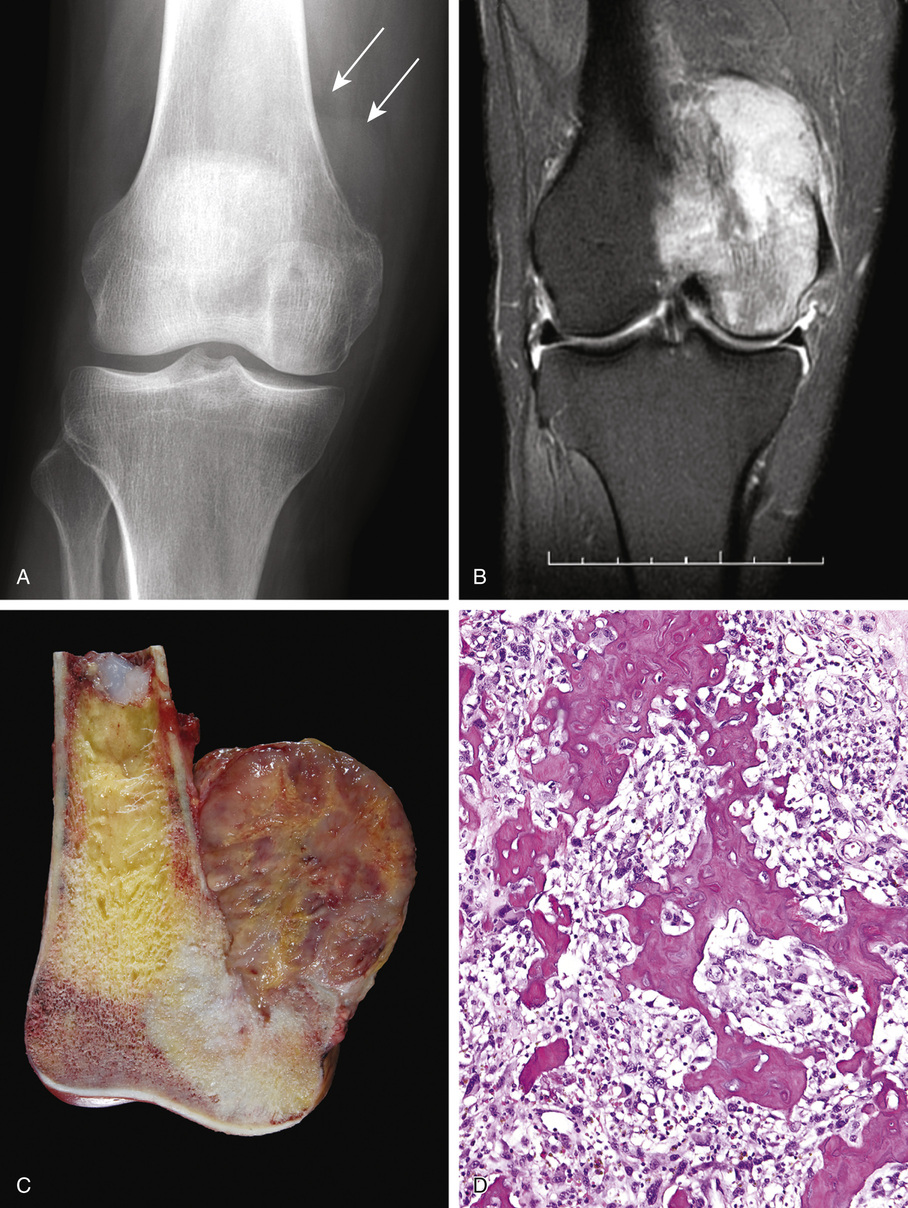 Osteosarcoma | Basicmedical Key