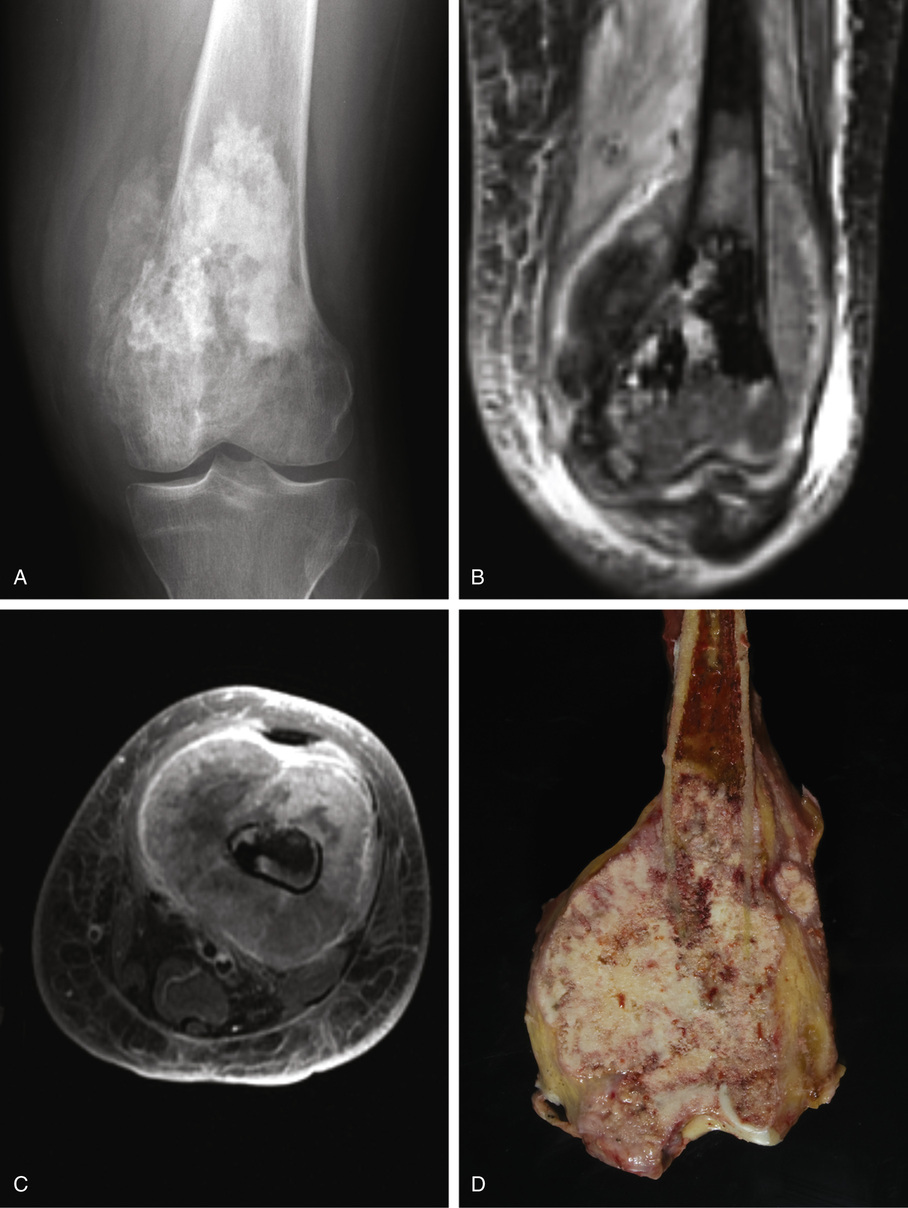 Osteosarcoma | Basicmedical Key