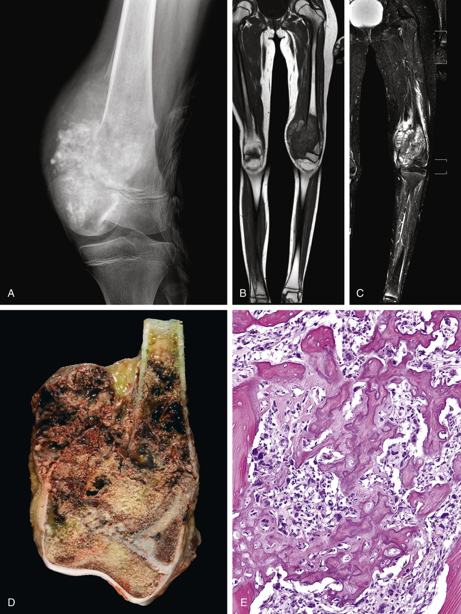 Osteosarcoma | Basicmedical Key