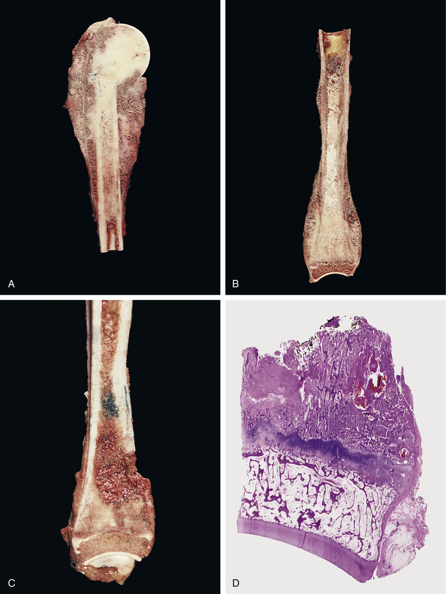 Osteosarcoma | Basicmedical Key