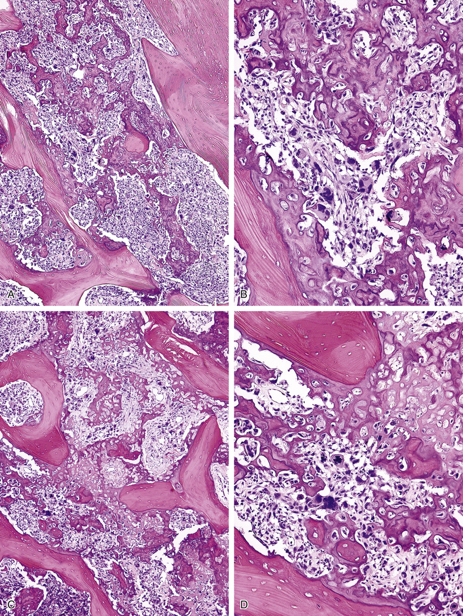 Osteosarcoma | Basicmedical Key