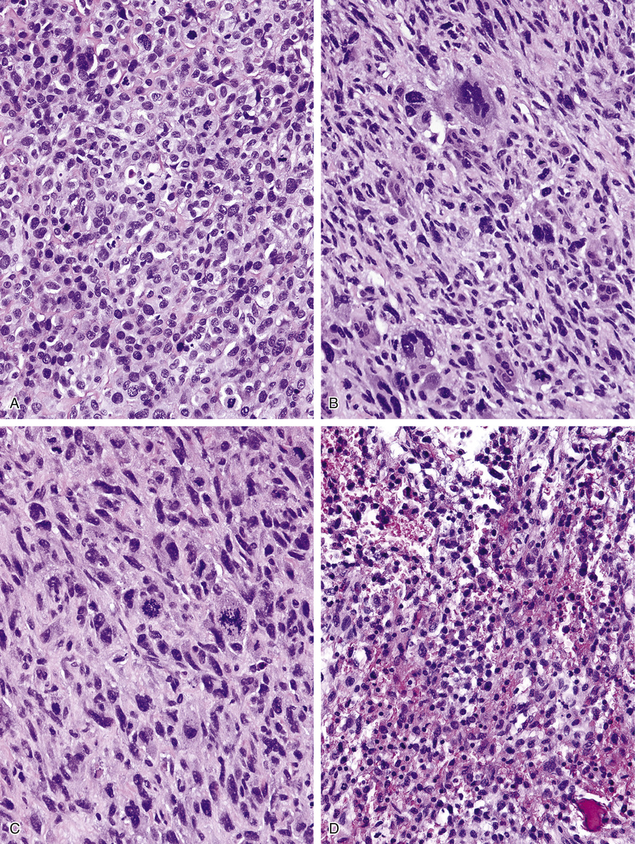 Osteosarcoma | Basicmedical Key