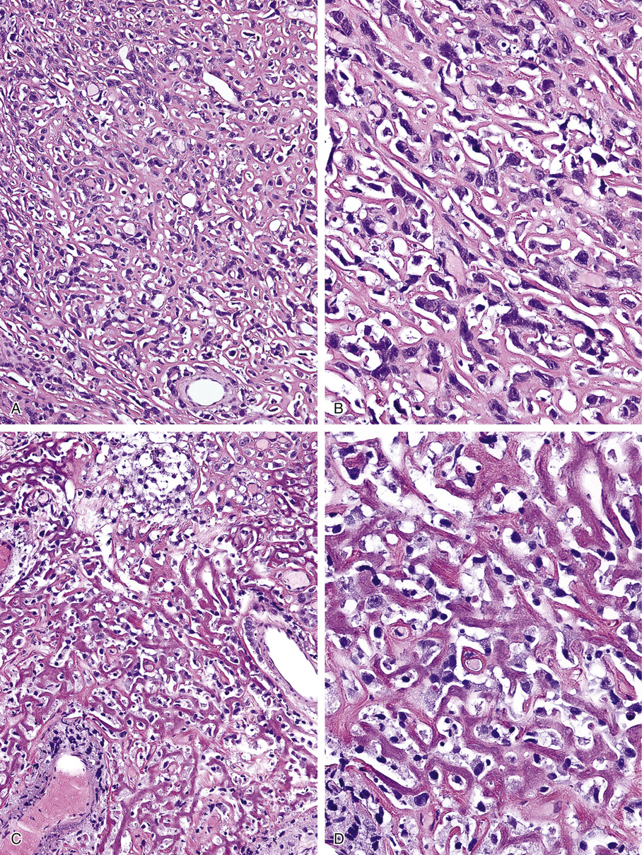 Osteosarcoma | Basicmedical Key