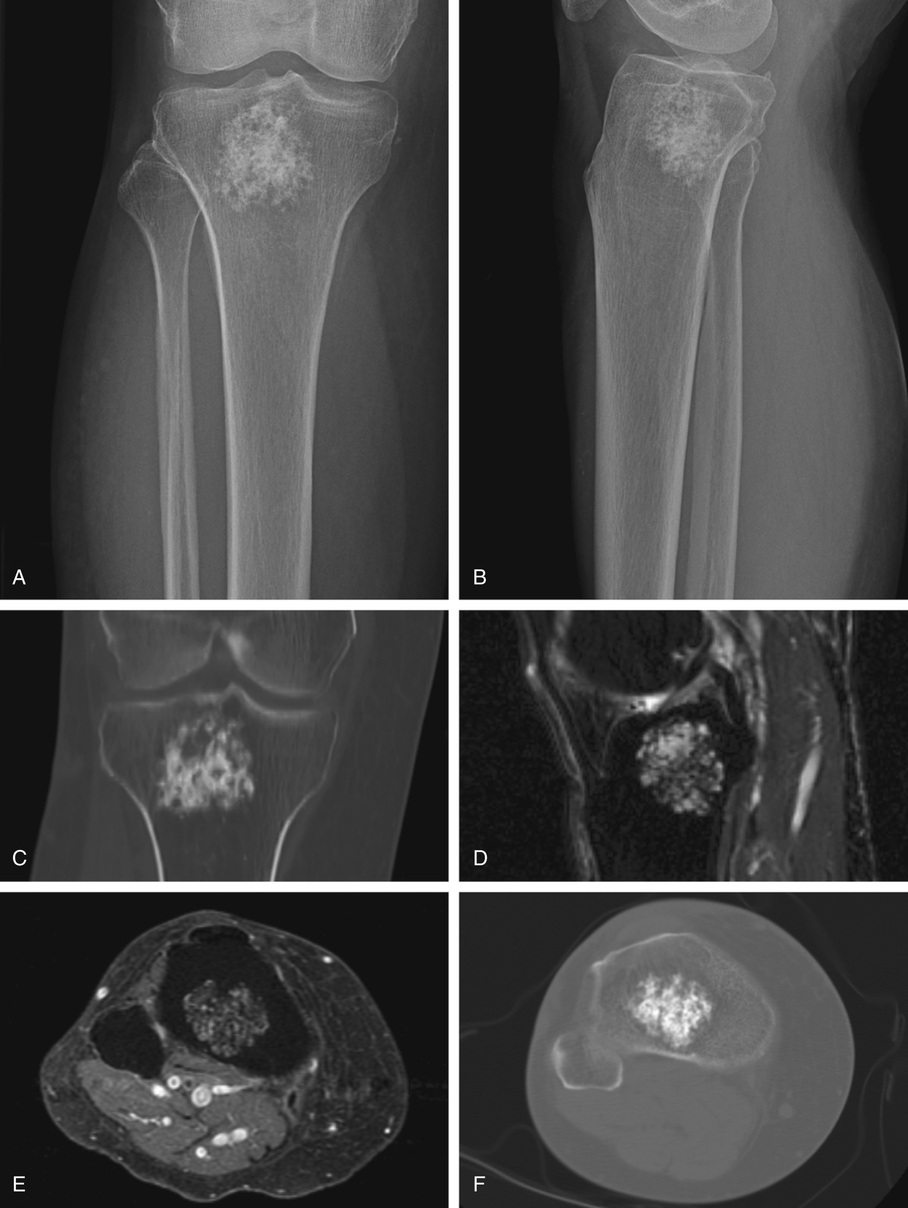 Benign Cartilage Lesions | Basicmedical Key