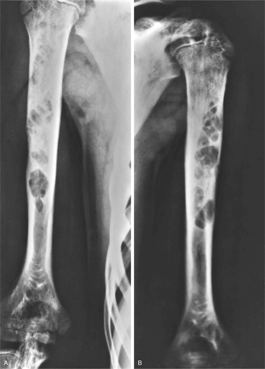 Fibrous And Fibrohistiocytic Lesions | Basicmedical Key