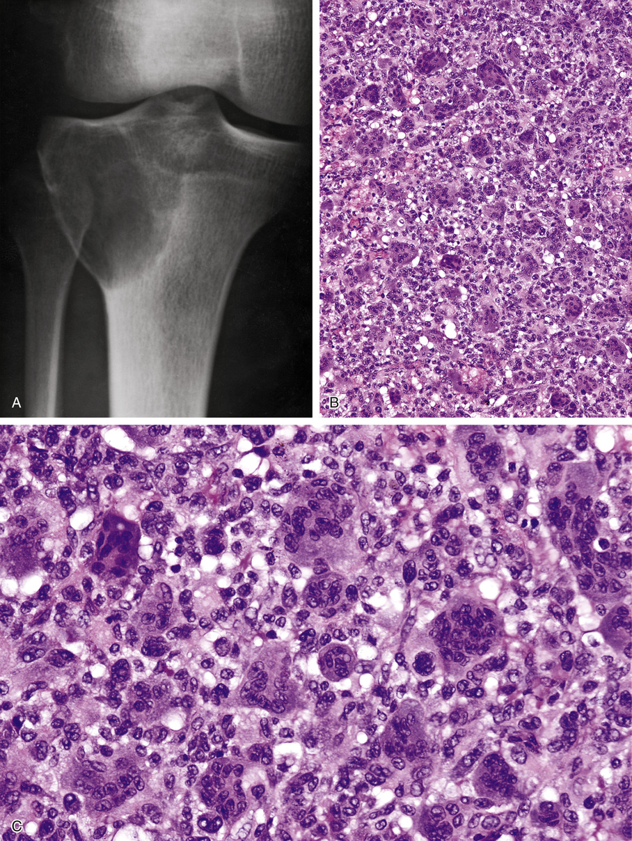 Giant Cell Lesions | Basicmedical Key