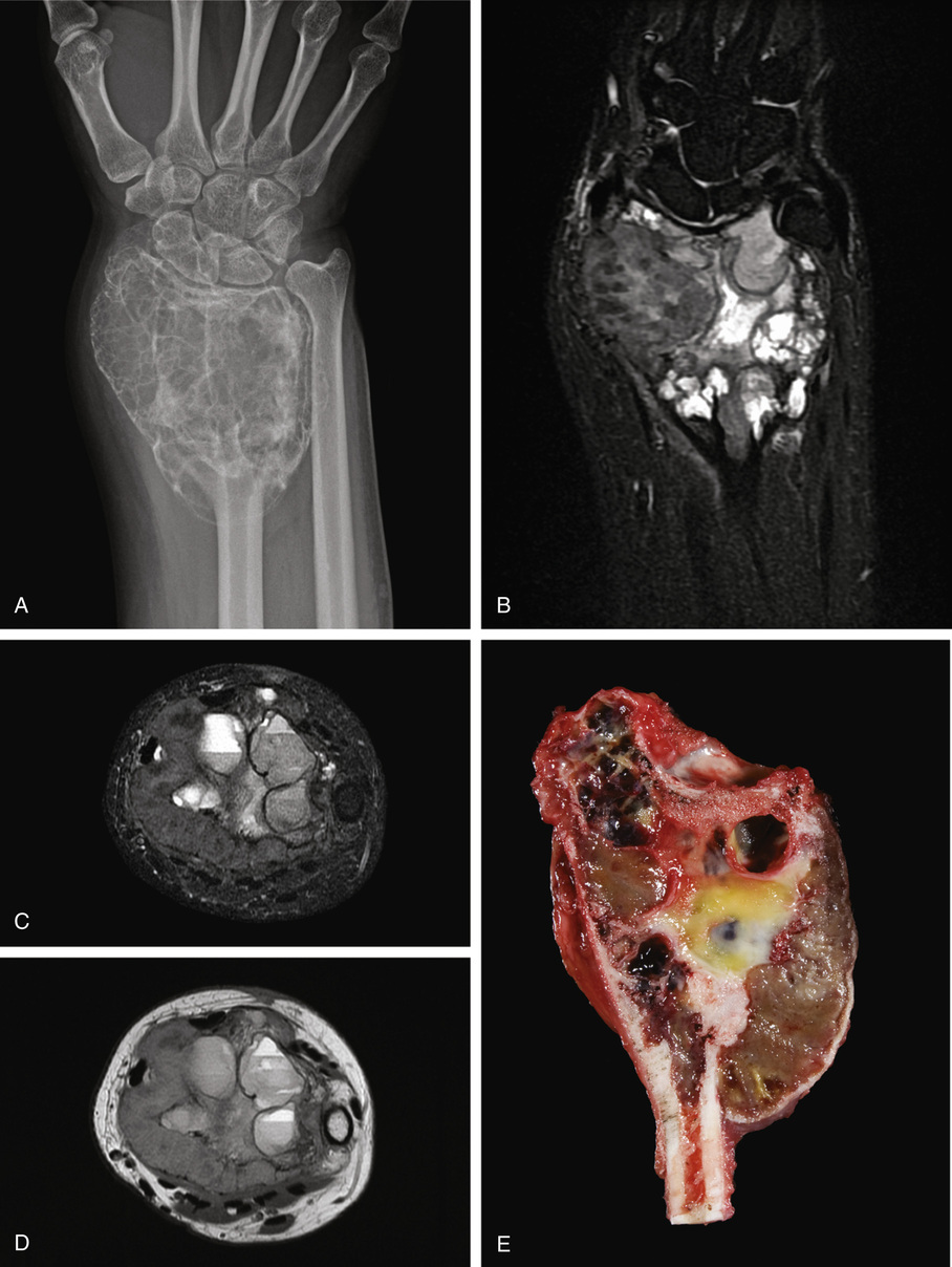 Giant Cell Lesions | Basicmedical Key