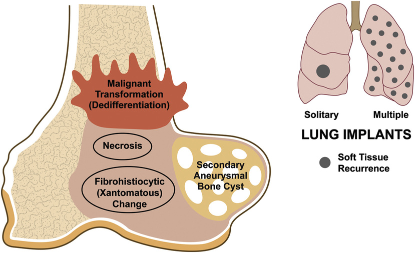 Giant Cell Lesions | Basicmedical Key