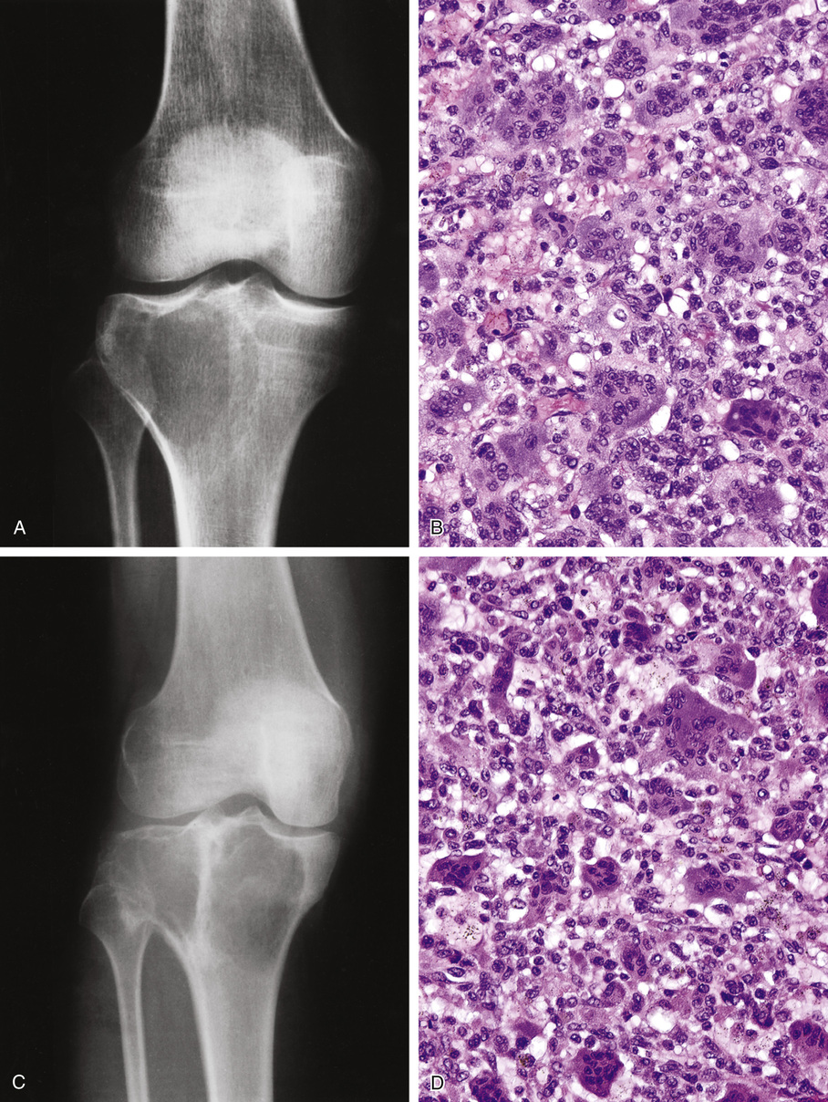 Giant Cell Lesions | Basicmedical Key