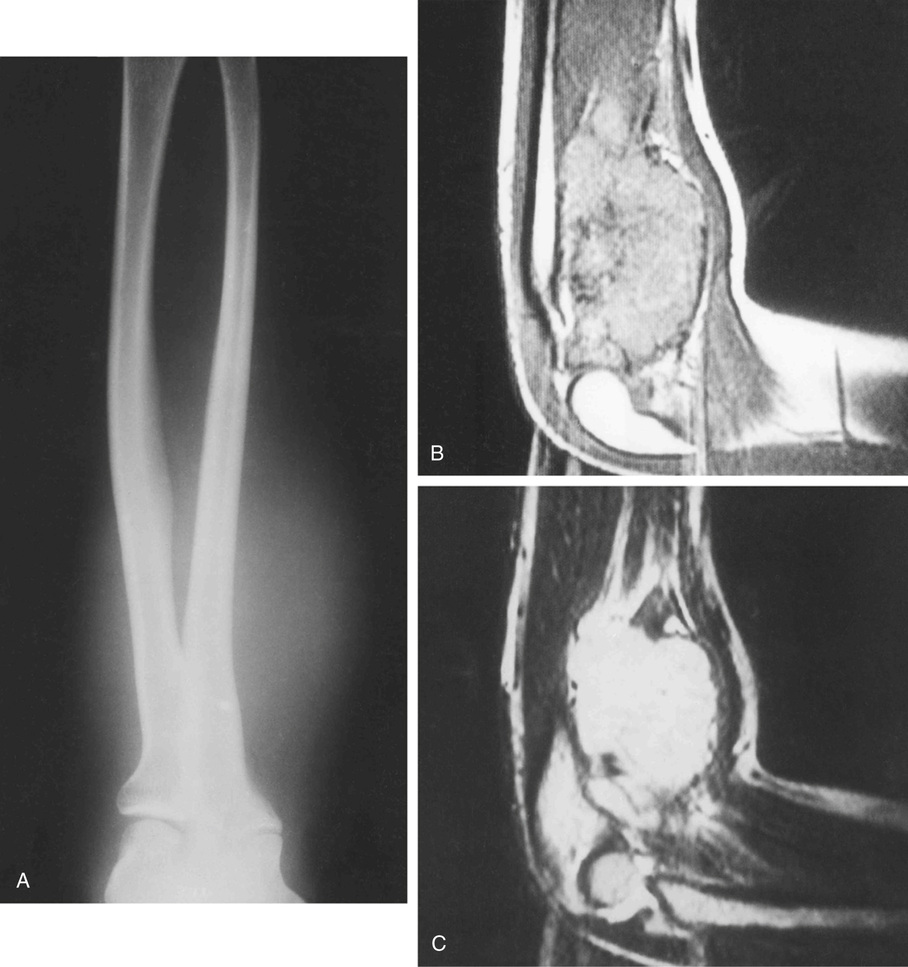 Ewing’s Sarcoma And Related Tumors | Basicmedical Key