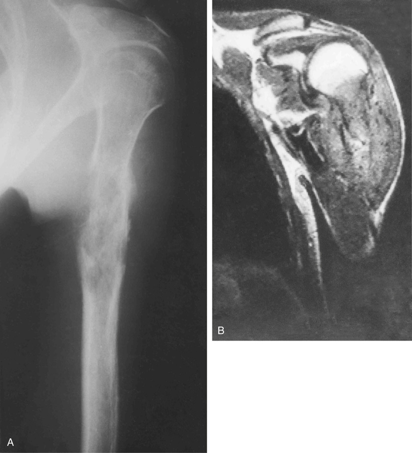 Ewing’s Sarcoma And Related Tumors | Basicmedical Key