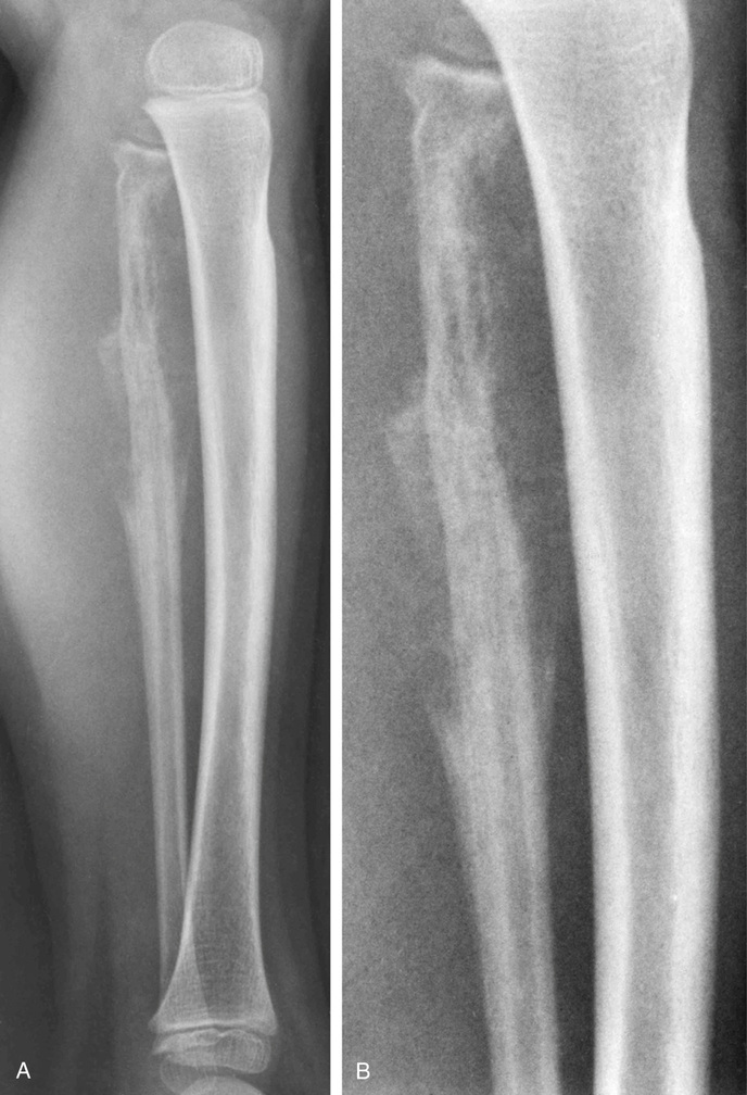 Ewing’s Sarcoma And Related Tumors | Basicmedical Key