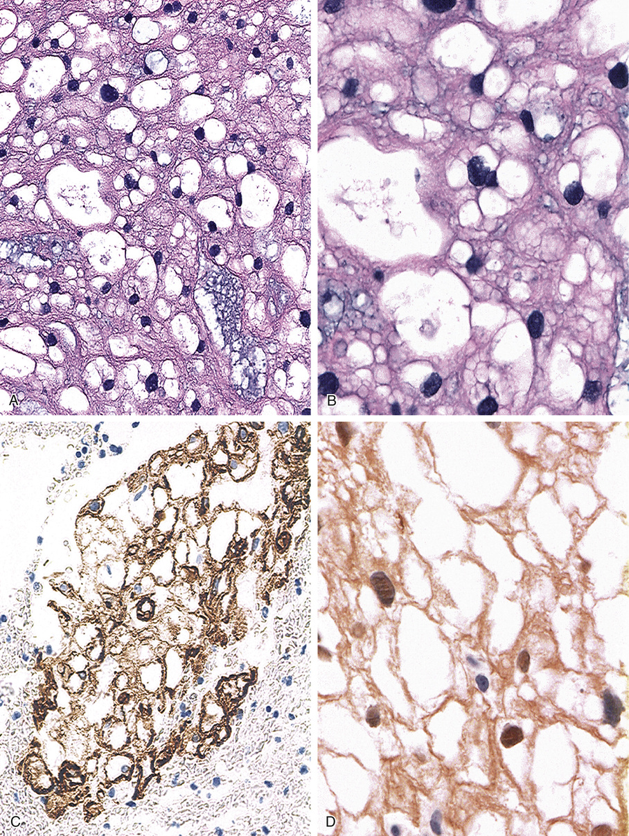 Chordoma And Related Lesions | Basicmedical Key