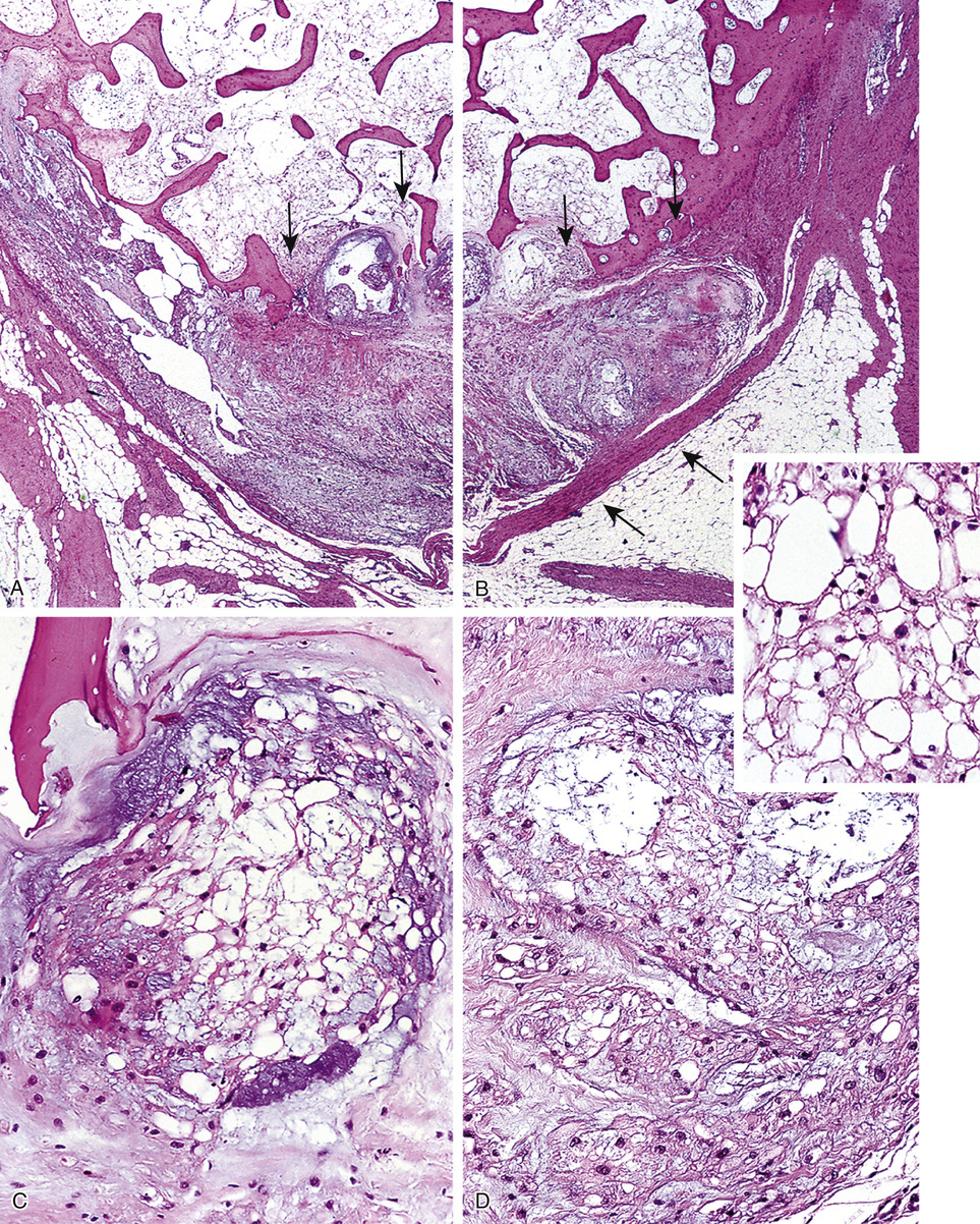 Chordoma And Related Lesions | Basicmedical Key