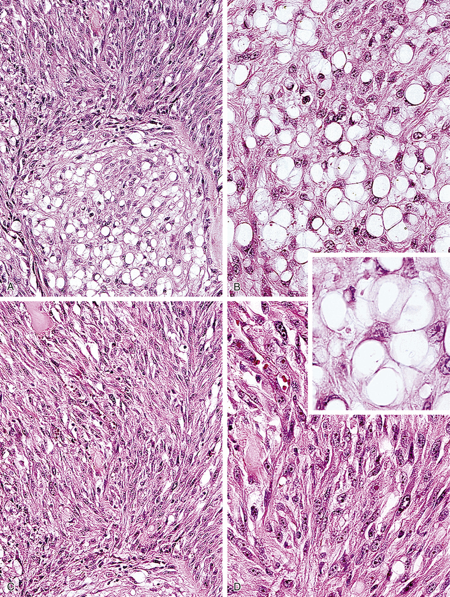 Chordoma And Related Lesions | Basicmedical Key