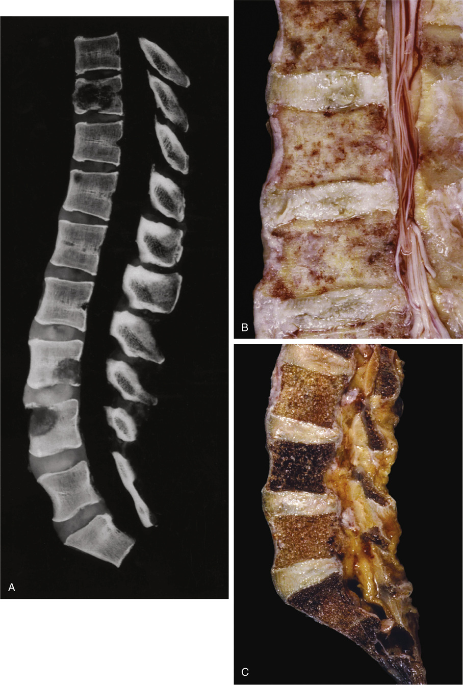 Metastatic Tumors In Bone | Basicmedical Key