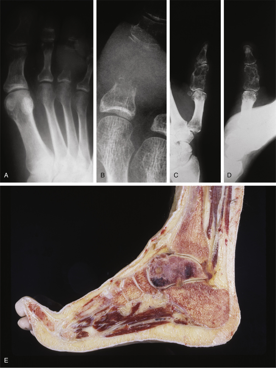 Metastatic Tumors In Bone | Basicmedical Key