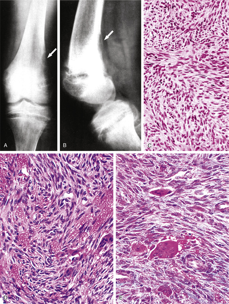 Osteomalacia Rickets