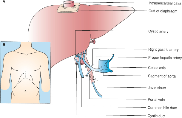 Hepatic Transplantation | Basicmedical Key