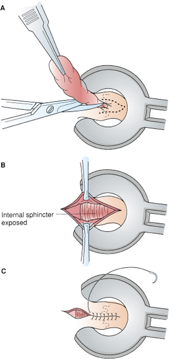 Anorectal Disorders | Basicmedical Key