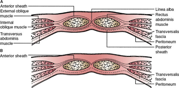 Abdominal Wall Hernias | Basicmedical Key