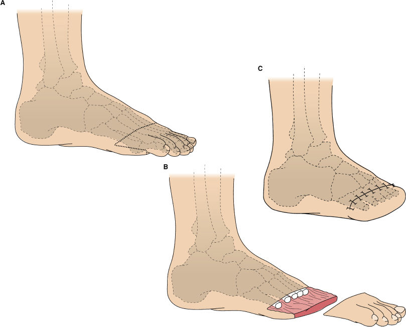 Lower Extremity Amputation | Basicmedical Key