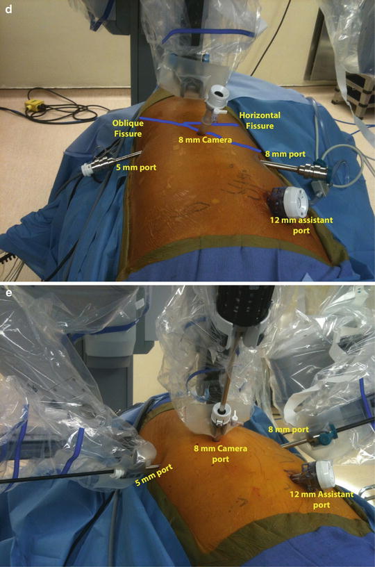 Complete Port-Access Robotic-Assisted Lobectomy Utilizing Three-Arm ...