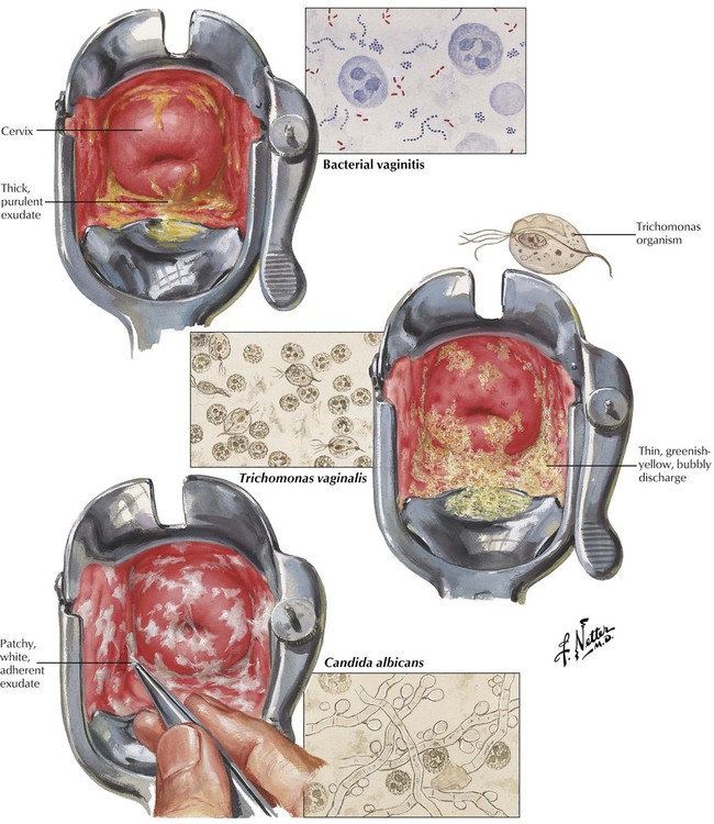 Diseases Of The Female Reproductive System | Basicmedical Key