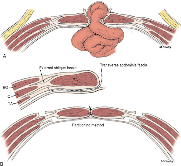 Damage Control: Abdominal Closures | Basicmedical Key