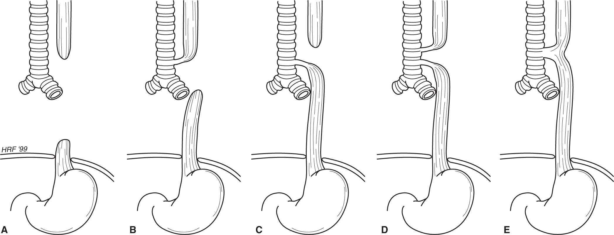 Pediatric Surgery: Surgical Diseases Of Children | Basicmedical Key