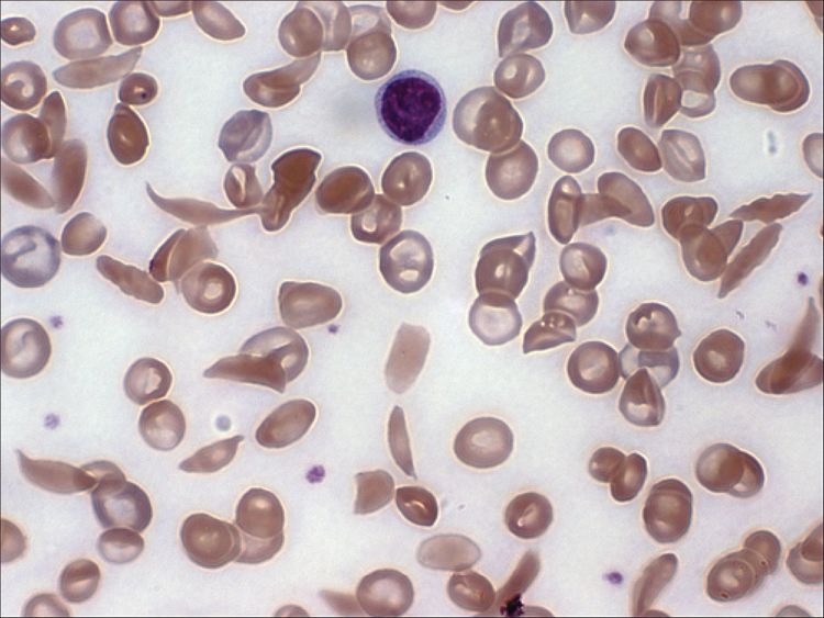 Anemia And Hemoglobinopathies | Basicmedical Key