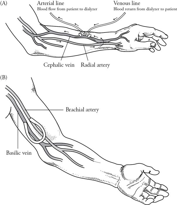 Acute Kidney Injury | Basicmedical Key