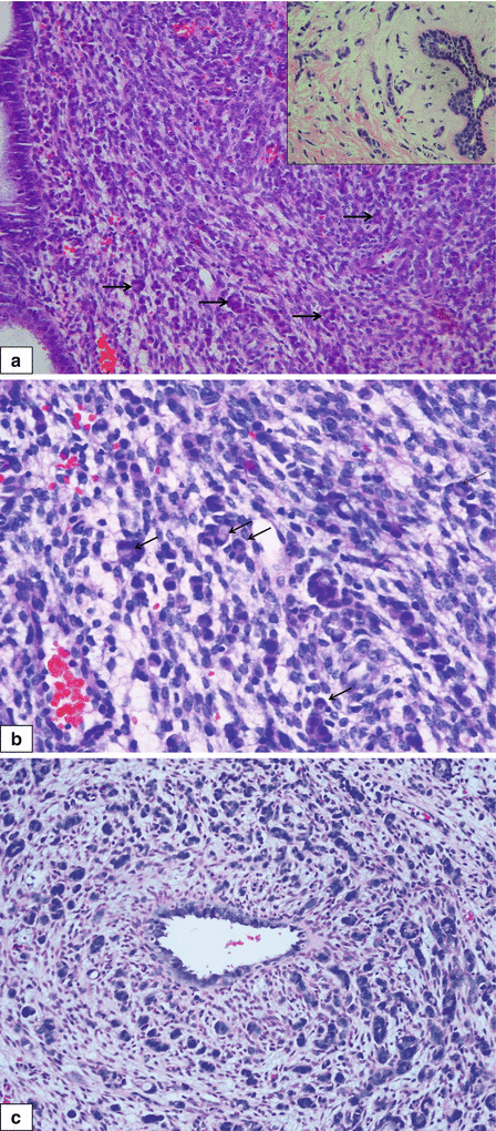 Lobular Lesions Lobular Neoplasia Invasive Lobular Carcinoma