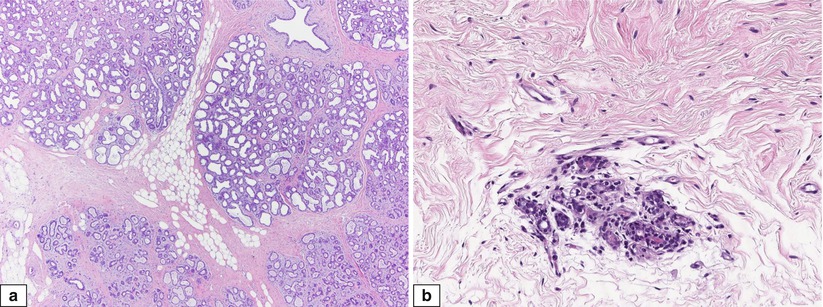 Normal Breast And Physiological Changes | Basicmedical Key