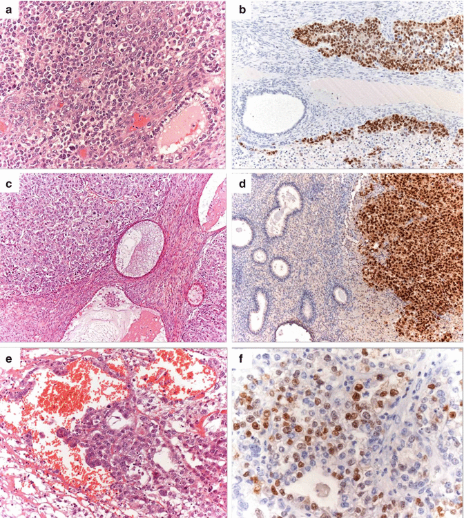 Germ Cell Tumors From A Developmental Perspective: Cells Of Origin ...